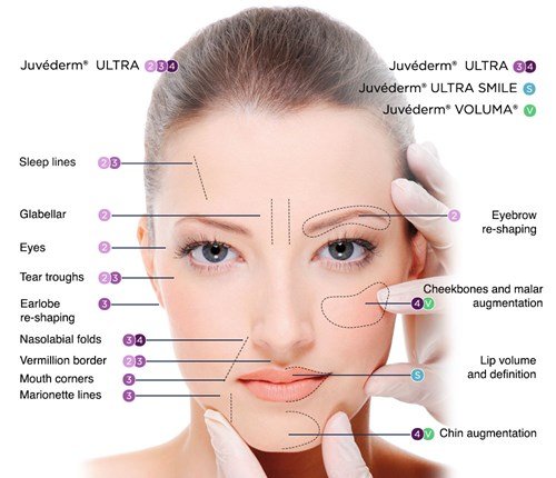 juvederm
